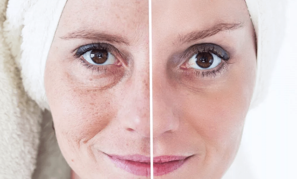 rexuvenecemento facial con láser